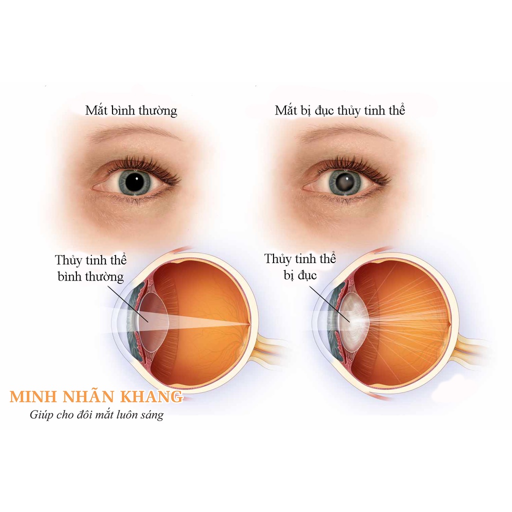 &lt;TẶNG 1 HỘP 30 VIÊN&gt; MINH NHÃN KHANG - HỘP 180 VIÊN - HỖ TRỢ NGỪA ĐỤC THỦY TINH THỂ, GIẢM THỊ LỰC, THOÁI HÓA ĐIỂM VÀNG