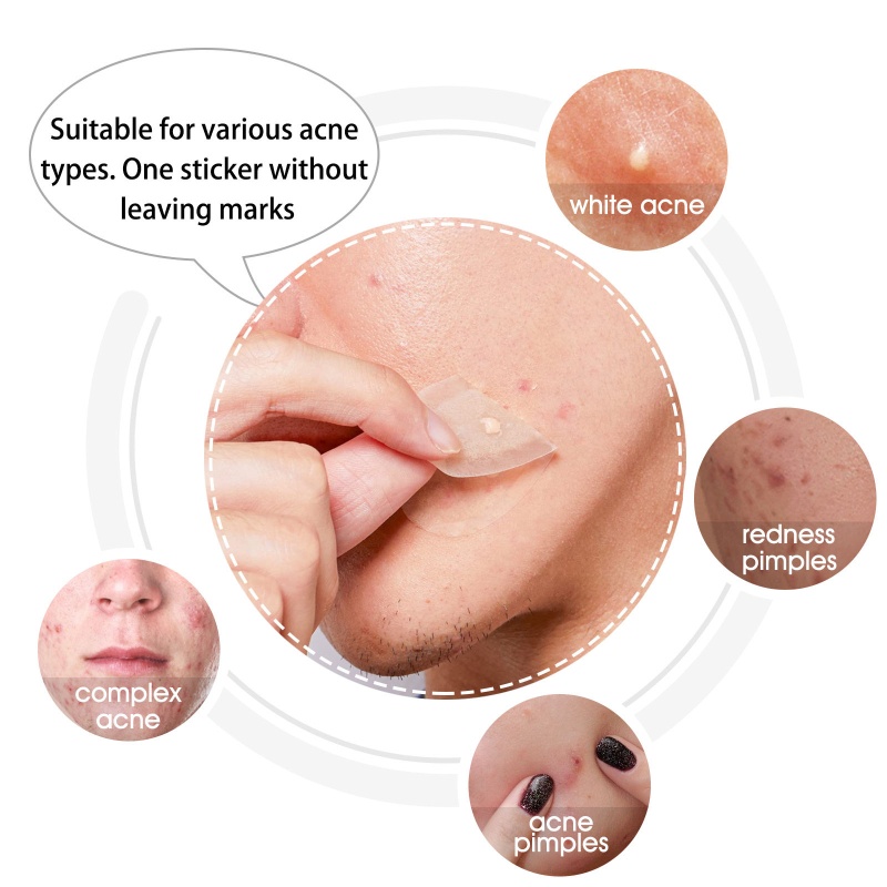 Bộ 20 Miếng Dán Hỗ Trợ Giảm Mụn Hấp Thụ Hydrocolloid Zit S