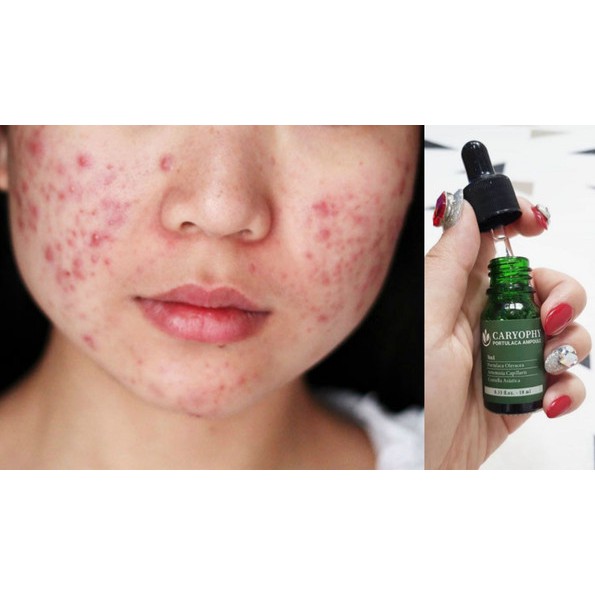 Tinh Chất Caryophy Portulaca Ampoule 10ml | BigBuy360 - bigbuy360.vn