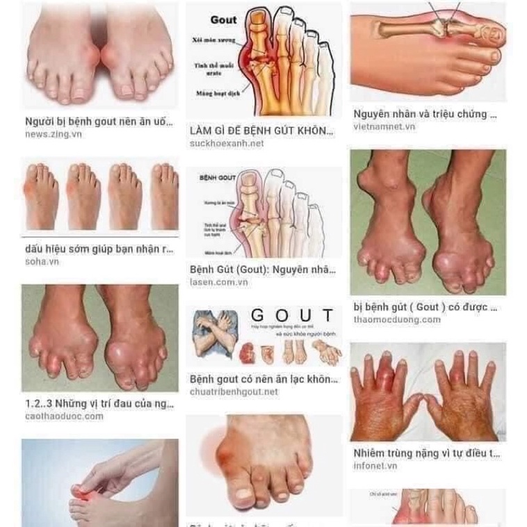 Viên uống hỗ trợ phòng chống và giảm Gout Anserine Minami Nhật Bản