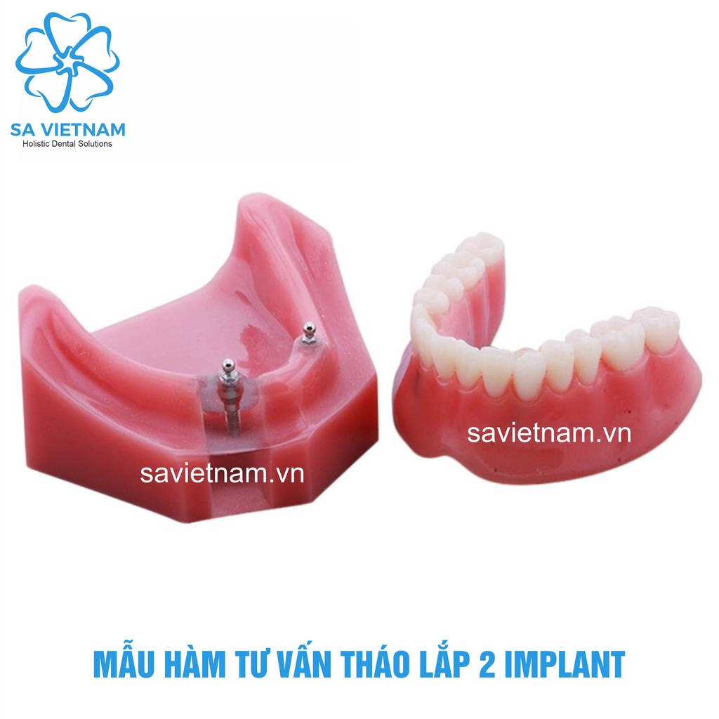 Mẫu tư vấn tháo lắp 2 implant, 4 implant - Hàm tư vấn nha khoa, Mẫu tư vấn nha khoa