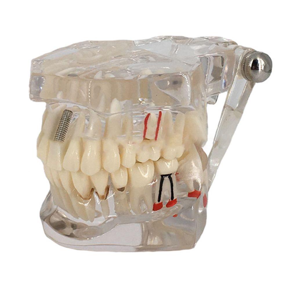 Mô Hình Hàm Răng Giả Có Thể Tháo Rời ESPO