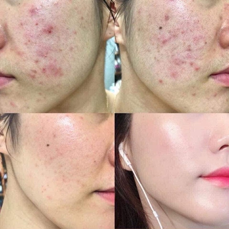 Tinh chất dưỡng sáng mờ thâm The Ordinary Niacinamide 10% + ZinC 1% 30ml