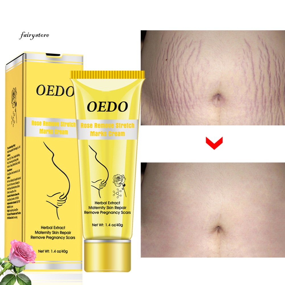 [Hàng mới về] Tuýp kem OEDO hỗ trợ xóa mờ các vết sẹo da sau sinh chất lượng cao