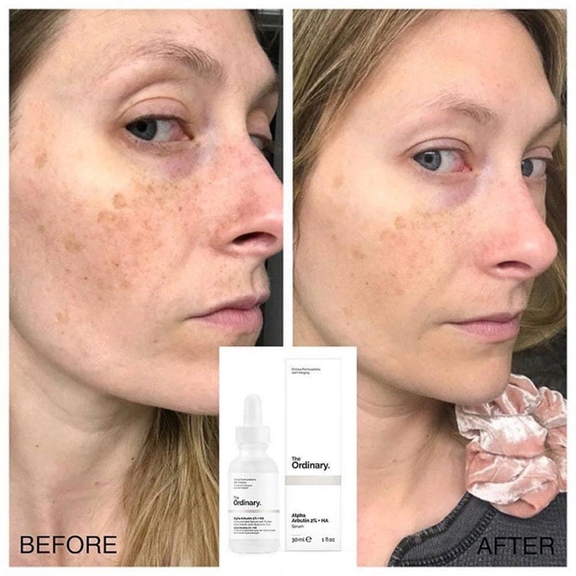 Serum Dưỡng Trắng The Ordinary Alpha Arbutin 2% + HA 30ml | BigBuy360 - bigbuy360.vn