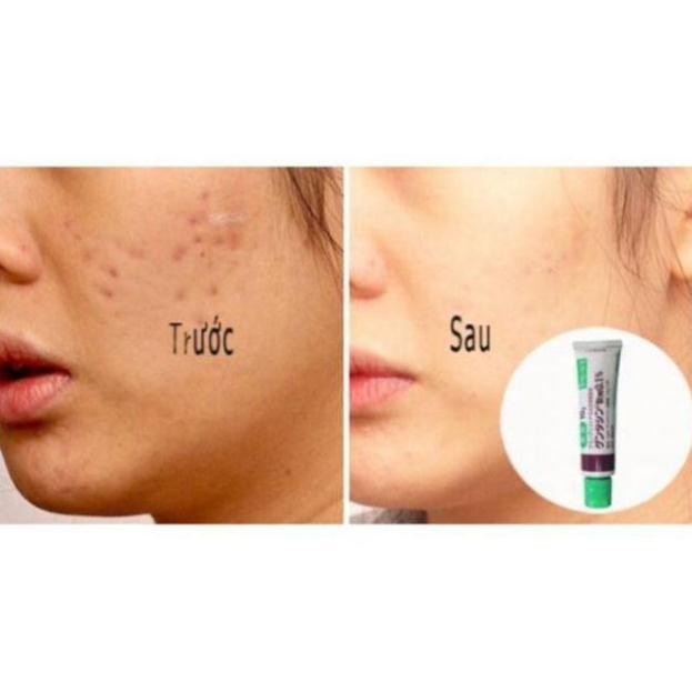 Kem ngừa mụn, ngăn sẹo Gentacin Takata Gentamicine Nhật Bản | BigBuy360 - bigbuy360.vn