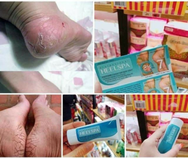 Kem Thoa Nứt Gót Chân HEELSPA Thái Lan