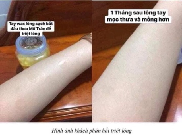 Mỡ trăn n'store triệt lông vĩnh viễn tại nhà (tặng kèm sách hướng dẫn)