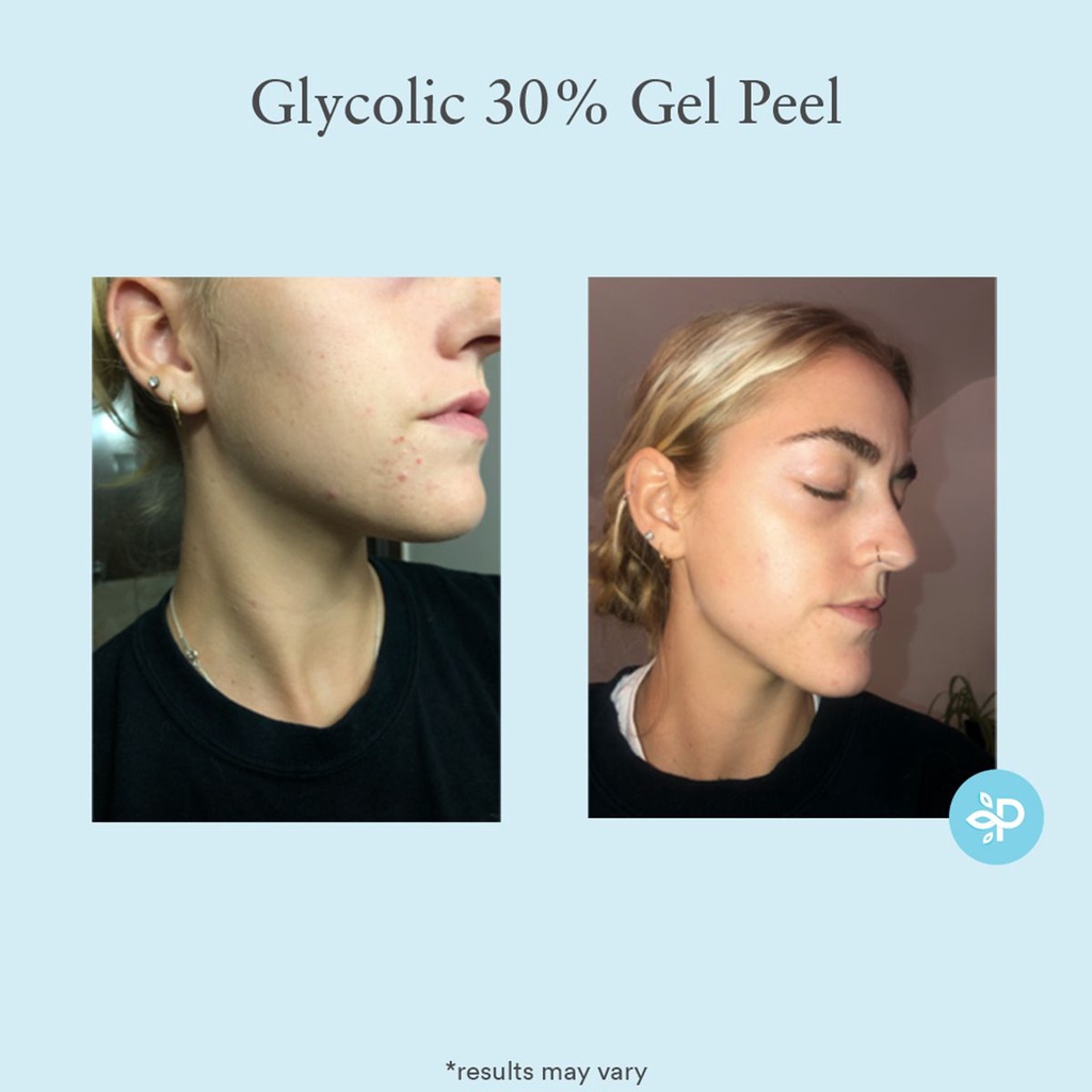 Thay da sinh học PEEL PERFECT IMAGE SALICYLIC ACID 20%, TCA 15%. GLYCOLIC ACID 50%, LACTIC ACID 50%