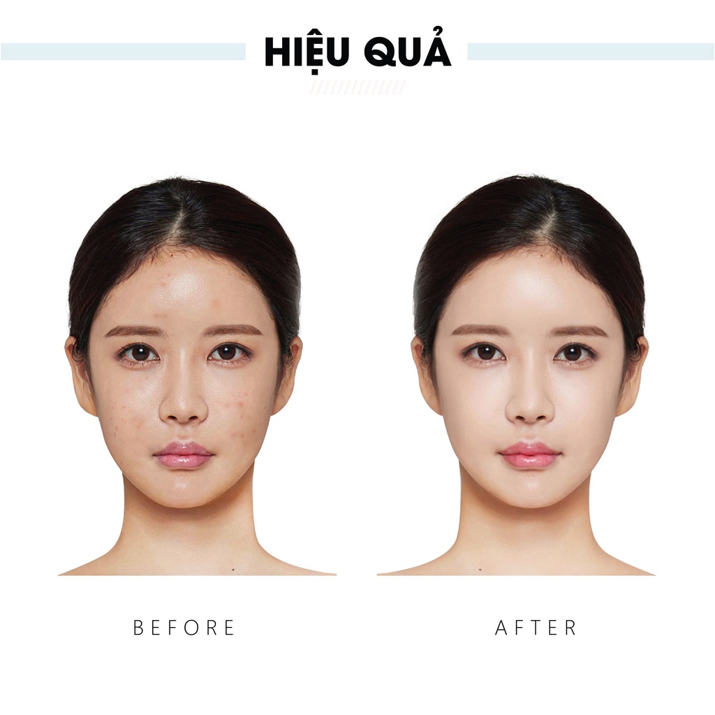 Serum giảm mụn và trắng da chiết xuất tràm trà Truesky Whitening Acne Serum 20ml