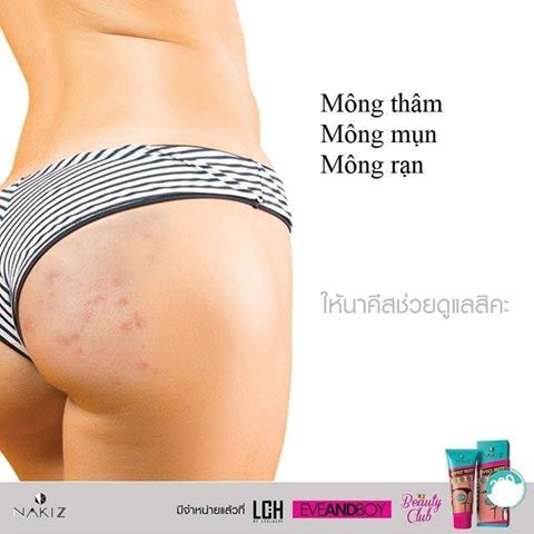 NAKIZ LIVELY BUTTS - Kem Nakiz cải thiện thâm & mụn vùng MÔNG/ BẸN/ LƯNG/ NÁCH/ CÙI CHỎ/ ĐẦU GỐI