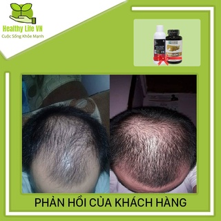Combo Mọc Tóc Hói Morr F5 + HairFluence