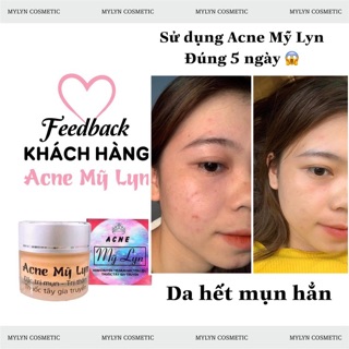 Acne Mỹ Lyn ( Kèm quà tặng )