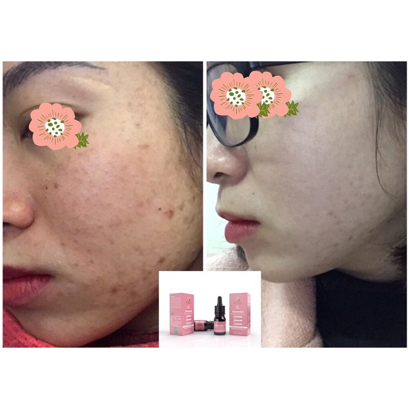 Serum Black Diamond giảm mụn thải độc se khít lcl kiềm dầu chiết xuất nhân sâm và nấm linh chi đỏ 5ml | BigBuy360 - bigbuy360.vn