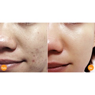 Con Lăn Trẻ hóa da Trị sẹo Derma Roller System