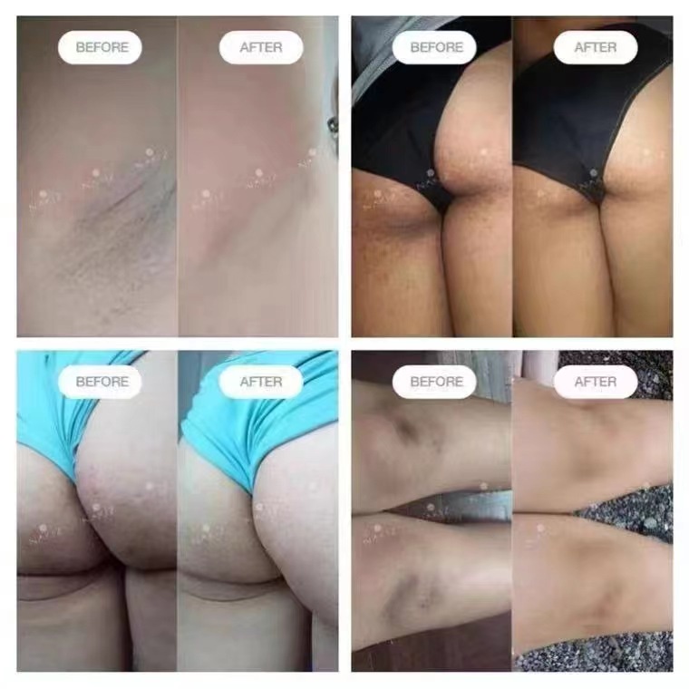 NAKIZ kem giảm thâm Mờ thâm thoa thâm mụn mông thâm bẹn thâm nhũ hoa thâm đầu gối thâm nách lưng ,cùi nhỏ trắng da