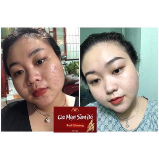 COMBO 2 CAO MỤN SÂM ĐỎ MEEA