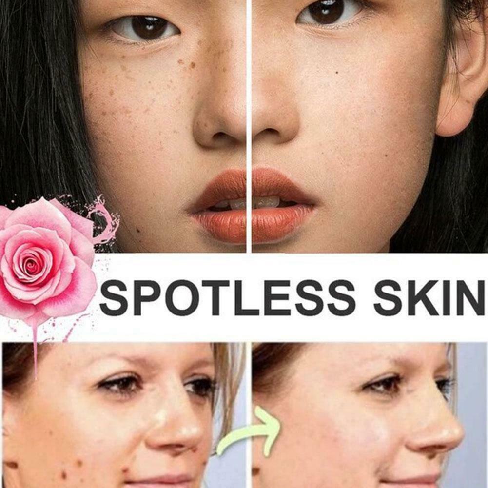 (Hàng Mới Về) Tinh Dầu Hữu Cơ 20ml Loại Bỏ Nốt Ruồi Hiệu Quả P6Q0 | BigBuy360 - bigbuy360.vn