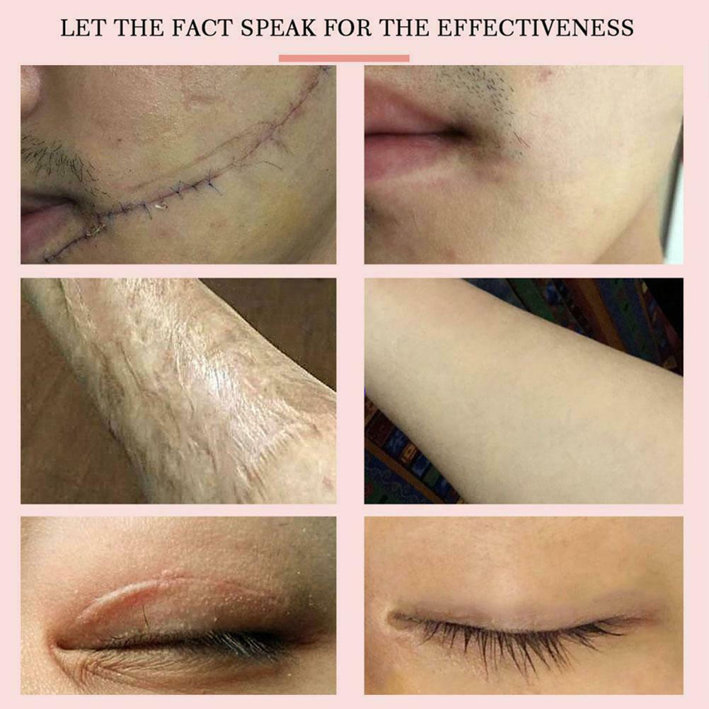 (Hàng Mới Về) Kem Hỗ Trợ Giảm Sẹo Chiết Xuất Hoa Oải Hương 20g | BigBuy360 - bigbuy360.vn