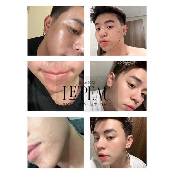 Peel da retinol vi tảo Le'Peau 10ml, Serum giảm mụn, tái tạo da sinh học, tặng kèm Serum B5 phục hồi,Hiệu quả sau 7 ngày