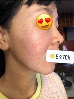 Tế bào gốc sẹo rỗ Cutiscura
