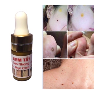 Tẩy nốt ruồi, mụn cóc ,tàn nhang ,mụn thịt , mắt cá hiệu quả