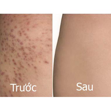 SERUM Thâm Mụn -Thâm Do Côn Trùng Đốt - Thâm Chân Tay - Nách- Bẹn