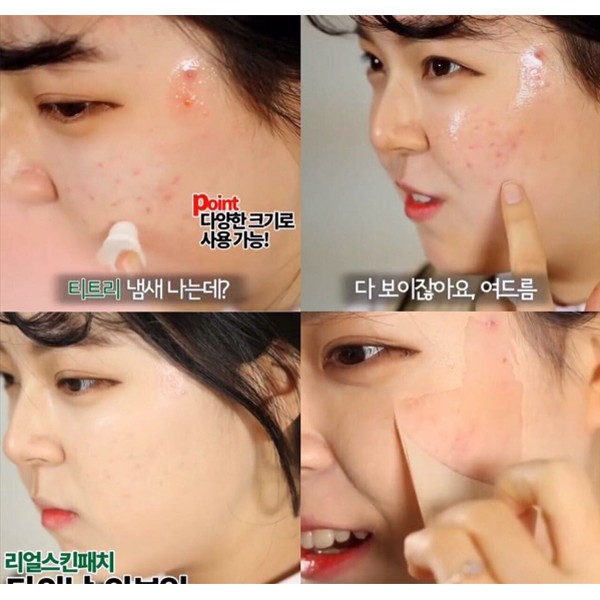 Gel Che Mụn Thần Thánh Not4U Real Skin Patch