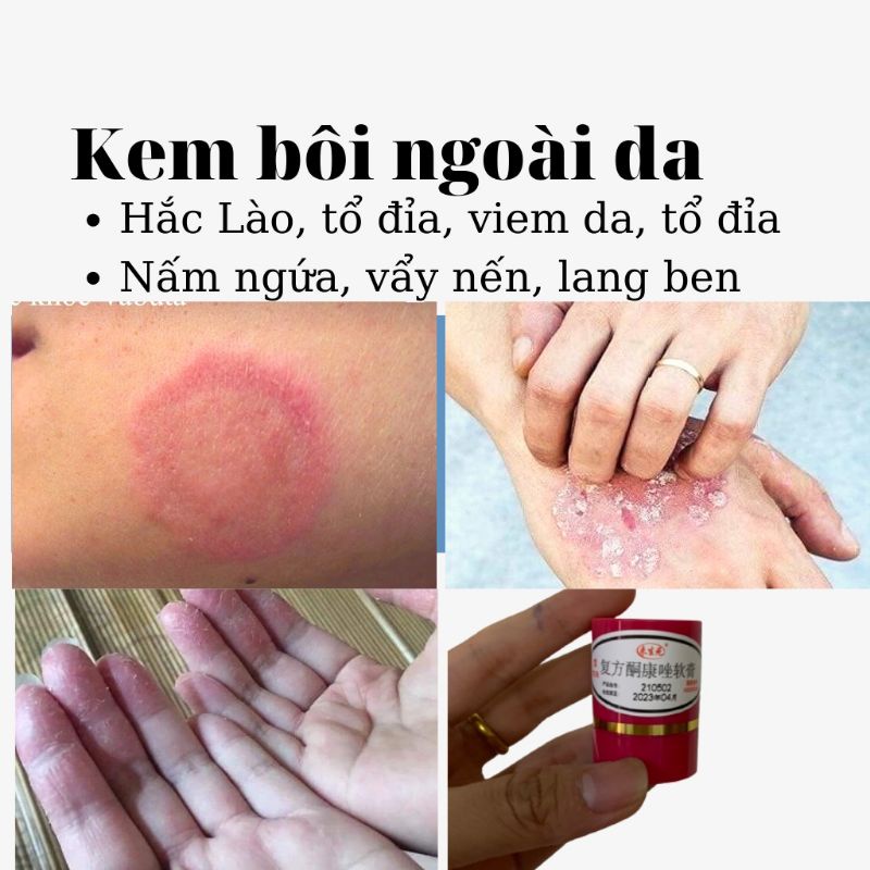 Kem Bôi Nấm Ngứa Ngoài Da, Hắc Lào Hl 7Gr. Hàng Sẵn