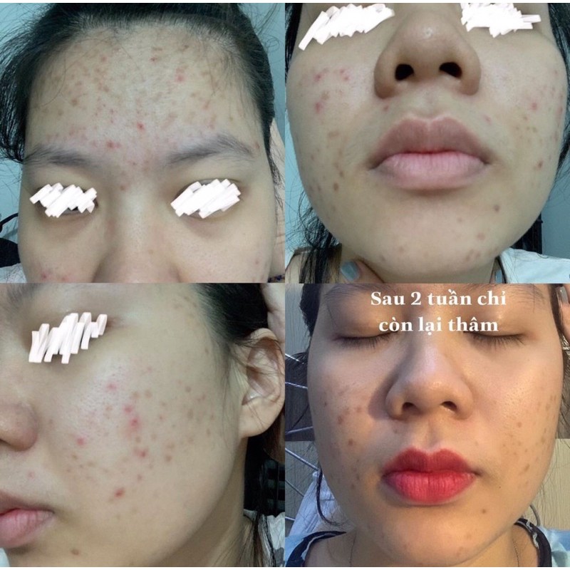 TURMERIC EXTRACT -ĐÁNH BAY MỤN ẨN VÀ CÁC LOẠI MỤN | BigBuy360 - bigbuy360.vn