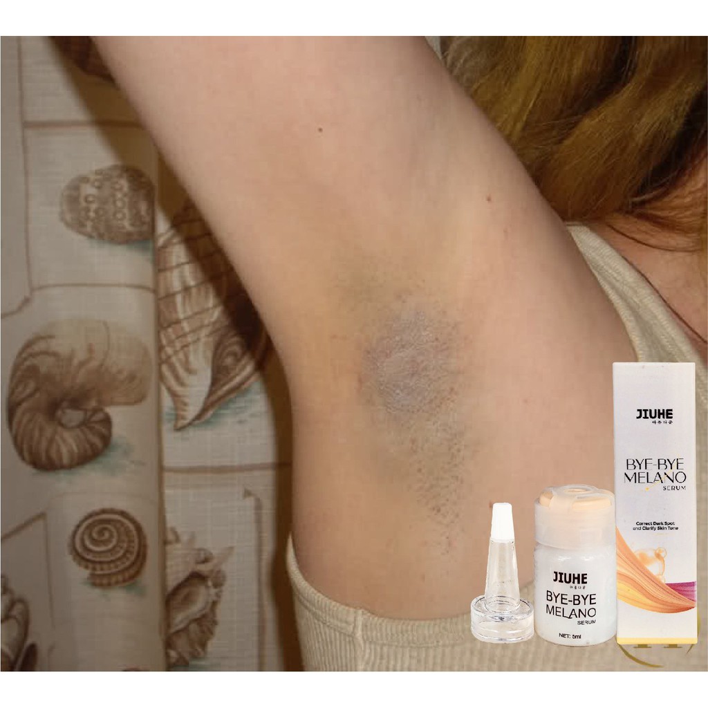 Serum tri thâm hàn quốc JIUHE Q-PEARL giảm thâm do mụn khửu tay chân, thâm sẹo, thâm nách hiệu quả | BigBuy360 - bigbuy360.vn