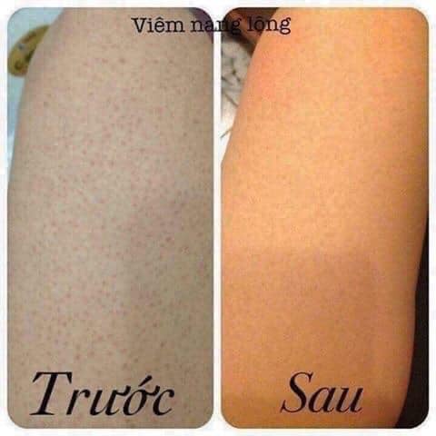 Viem nang lông Kela Thái Lan KELA LOTION Dành cho da Viêm Lỗ Chân Lông