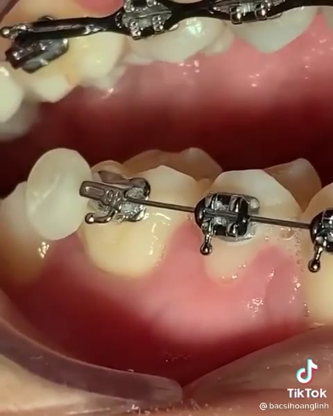 Thanh sáp nha khoa, sáp chỉnh nha hỗ trợ giảm đau khi niềng và vệ sinh răng cao cấp | BigBuy360 - bigbuy360.vn