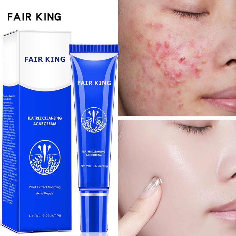 FAIR KING Loại bỏ Kem chống mụn làm trắng da mặt Làm sạch sâu Trị mụn Sẹo Thu nhỏ lỗ chân lông Điều trị Kem chăm sóc da mặt Sửa chữa mụn đầu đen