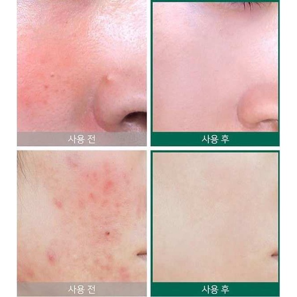 Kem Dưỡng Ẩm, Phục Hồi, Giảm Mụn Chiết Xuất Ốc Sên, Tràm Trà, AHA-BHA-PHA 30 Days Some By Mi Cream 60g
