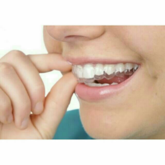 Máng tẩy trắng răng tại nhà khít răng 100%.