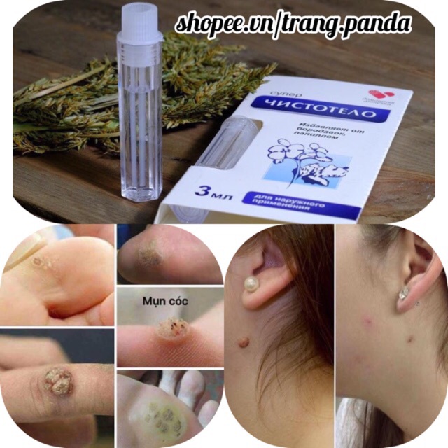 Tẩy nốt ruồi mụn cóc Nga
