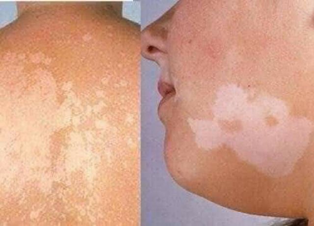 Kem bôi lang ben FANGO-B Thái Lan