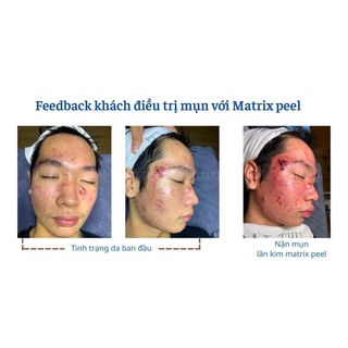 Serum mụn mờ thâm sạm dasamin matrix peel 30ml