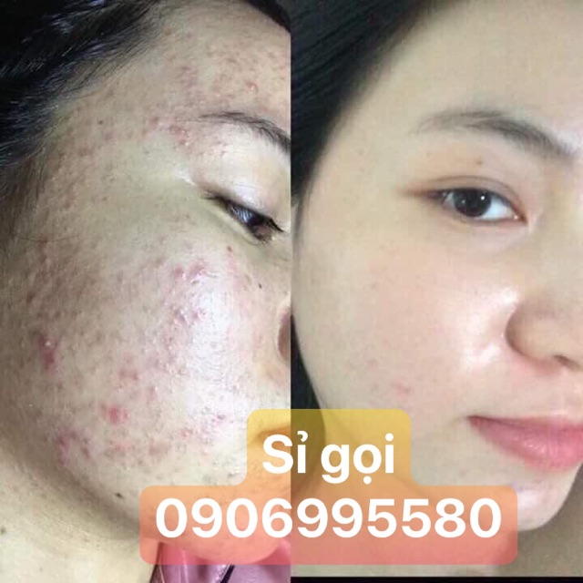 Serum Ediva Mụn thâm dịu da