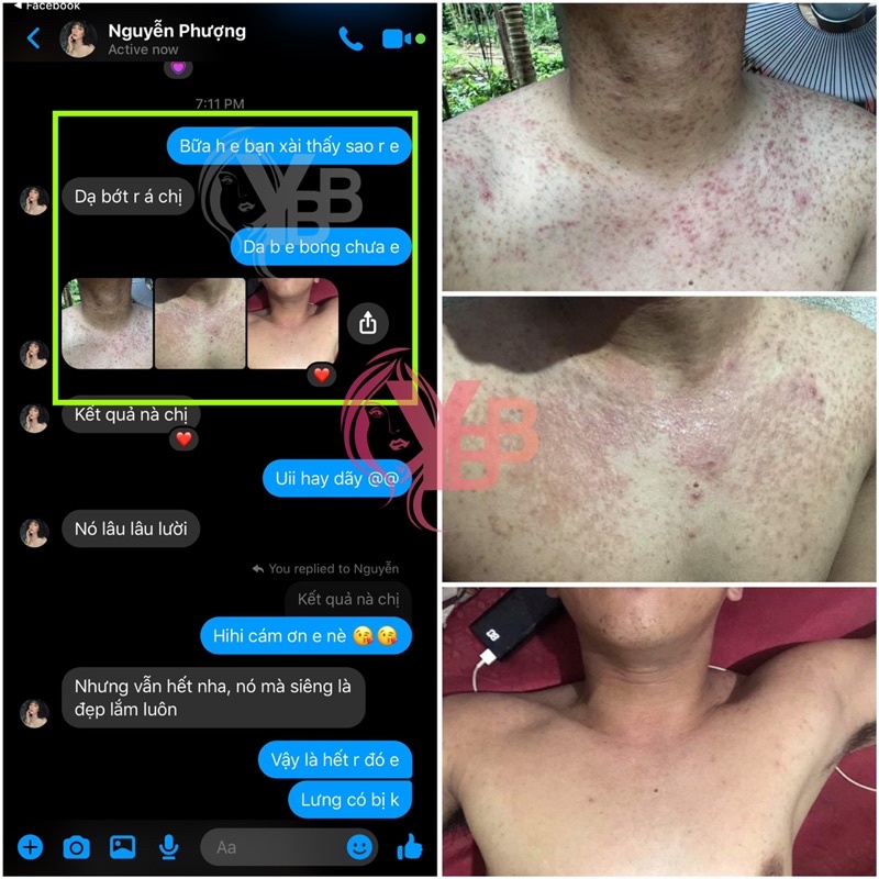 Nhất Nam Dược mụn lưng & mụn nang lông