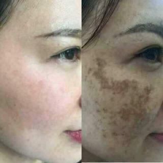 Bộ sản phẩm CLOBETAMIL G cao cấp
