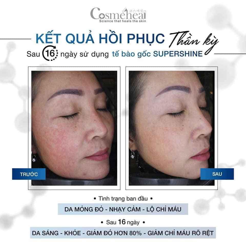Tế Bào Gốc Phục Hồi &amp; Căng Bóng Da Cosmeheal