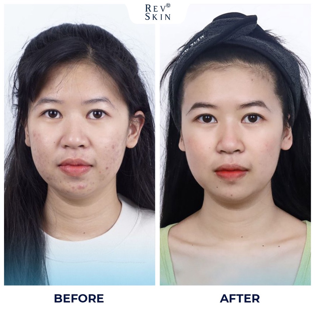 [DƯỢC MỸ PHẨM] Chấm Mụn Giảm Mụn, Giảm Thâm, Sẹo Rỗ RevSkin Acne Cực Kỳ Hiệu Qủa