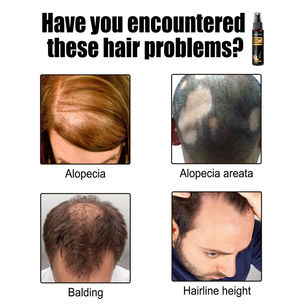 Tinh chất xịt Kopyrrol kích thích mọc tóc cải thiện chăm sóc da đầu 30ml