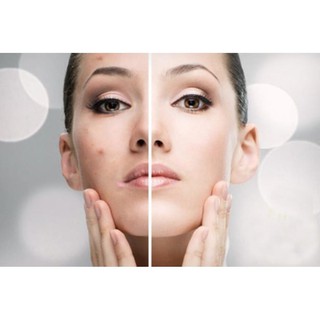 [MỚI] Gel Hút Mụn TitiOne 15g