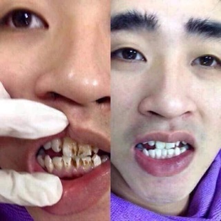 BỘT TRẮNG RĂNG THAN HOẠT TÍNH MINTY ACTIVE