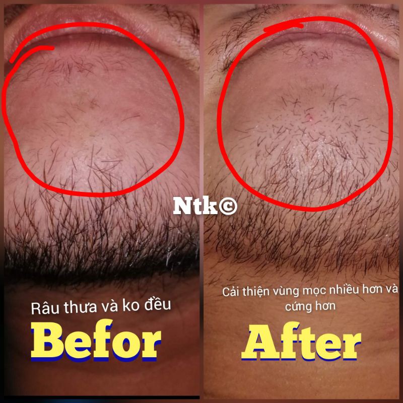 BEARD & HAIR Hỗ trợ mọc r.â.u quai nón, rậm chân mày, ngăn ngừa rụng tóc, mọc tóc