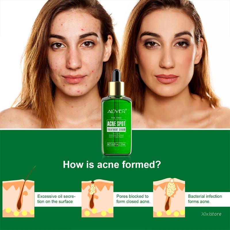 XIXI Serum Hỗ Trợ Giảm Mụn Chiết Xuất Tràm Trà Làm Sạch Da Hiệu Quả
 | BigBuy360 - bigbuy360.vn