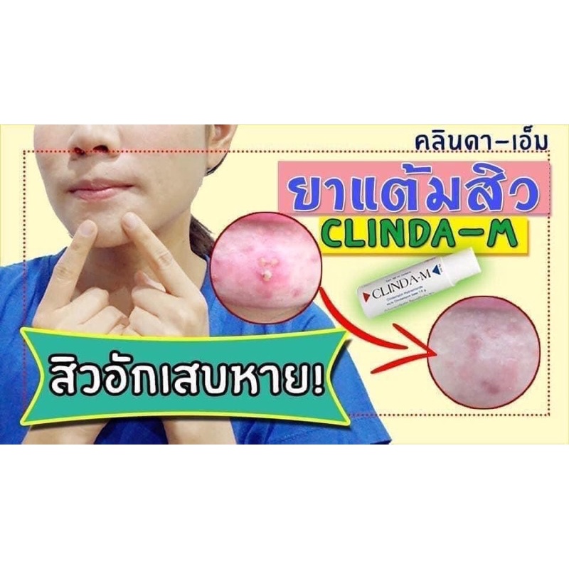 CHẤM MỤN CLINDA 15ml Thái lan